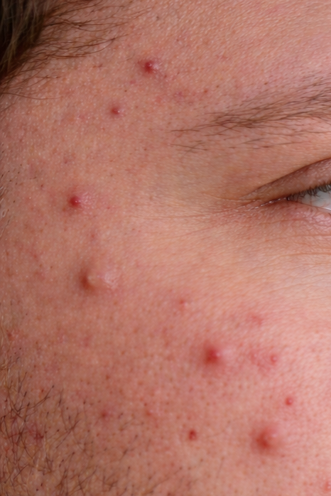 FEWER BREAKOUTS - Before