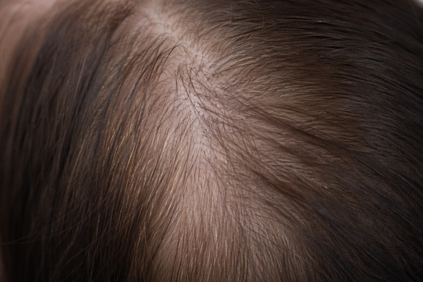 REDUCED HAIR SHEDDING - Before