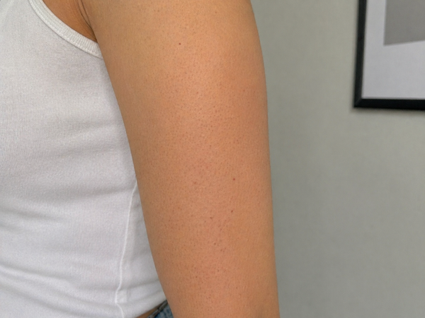 LESS IRRITATED SKIN - After