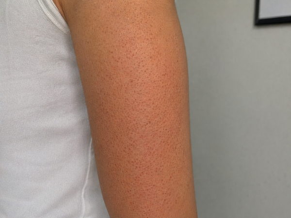 LESS IRRITATED SKIN - Before