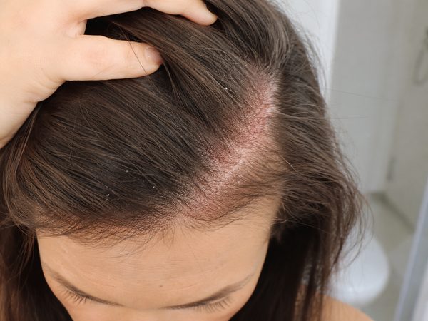 CALMER SCALP - Before