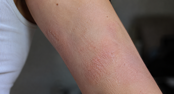 LESS IRRITATED SKIN - Before