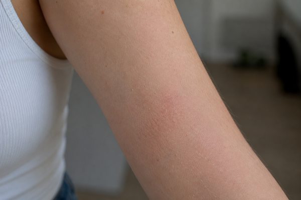 LESS IRRITATED SKIN - After