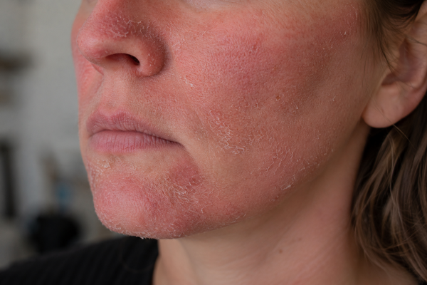 REDUCES TIGHT, DRY SKIN (MOST COMMON) - Before