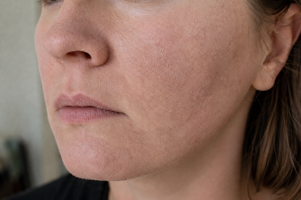 REDUCES TIGHT, DRY SKIN (MOST COMMON) - After